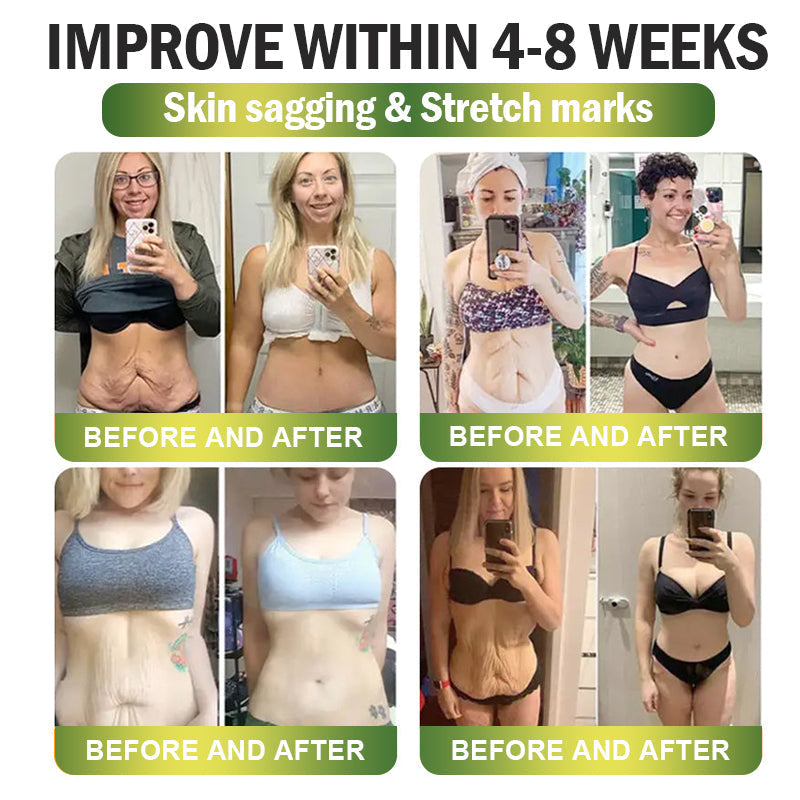 đAU Clinically Proven|Official Store | CrazyLeafÂź SMGT-GLP-1 Nano Microneedle Patch with Collagen & Matrixyl 3000 äžšTargets Obesity, Loose Skin, High Blood Pressure, Diabetes, Fatty Liver, Joint Pain, Brain Fog, Low Energy, Body Aches, and More