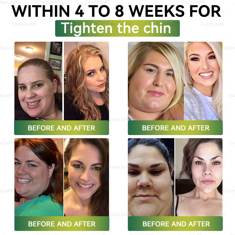 đAU Clinically Proven|Official Store | CrazyLeafÂź SMGT-GLP-1 Nano Microneedle Patch with Collagen & Matrixyl 3000 äžšTargets Obesity, Loose Skin, High Blood Pressure, Diabetes, Fatty Liver, Joint Pain, Brain Fog, Low Energy, Body Aches, and More