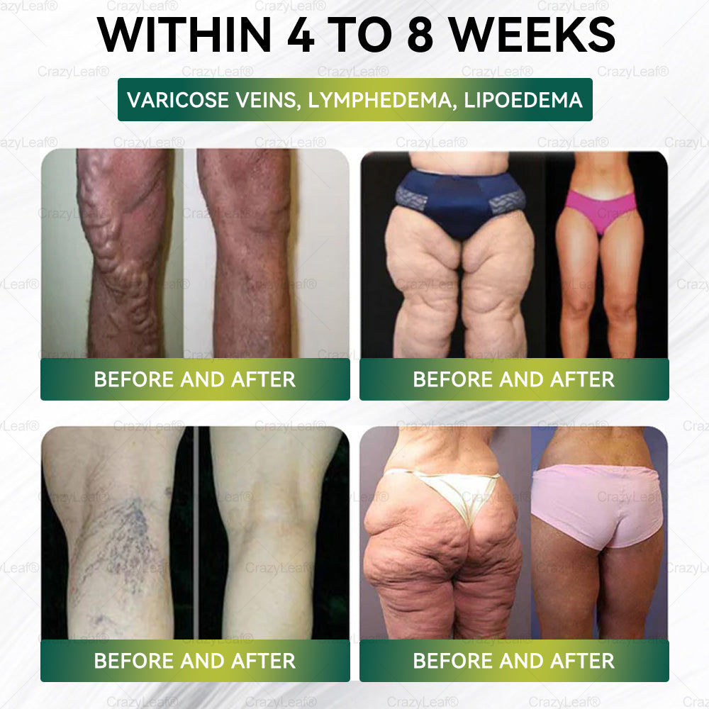 đAU Clinically Proven|Official Store | CrazyLeafÂź SMGT-GLP-1 Nano Microneedle Patch with Collagen & Matrixyl 3000 äžšTargets Obesity, Loose Skin, High Blood Pressure, Diabetes, Fatty Liver, Joint Pain, Brain Fog, Low Energy, Body Aches, and More