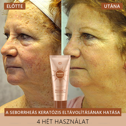 𝐅𝐑𝐈𝐒𝐒𝐀𝐑𝐂™ Fehérítő És Folteltávolító Arcmaszk | Természetes összetevők tartósan eltüntetik a foltokat, szeplőket és napfoltokat🔥