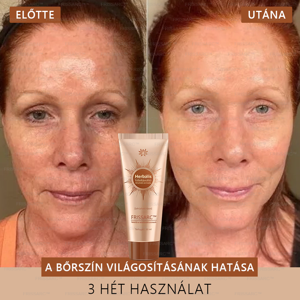 𝐅𝐑𝐈𝐒𝐒𝐀𝐑𝐂™ Fehérítő És Folteltávolító Arcmaszk | Természetes összetevők tartósan eltüntetik a foltokat, szeplőket és napfoltokat🔥